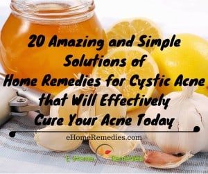 20 Amazing and Simple Solutions of Home Remedies for Cystic Acne that Will Effectively Cure Your Acne Today