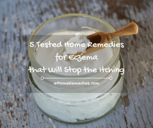 Read more about the article 5 Tested Home Remedies for Eczema that Will Stop the Itching
