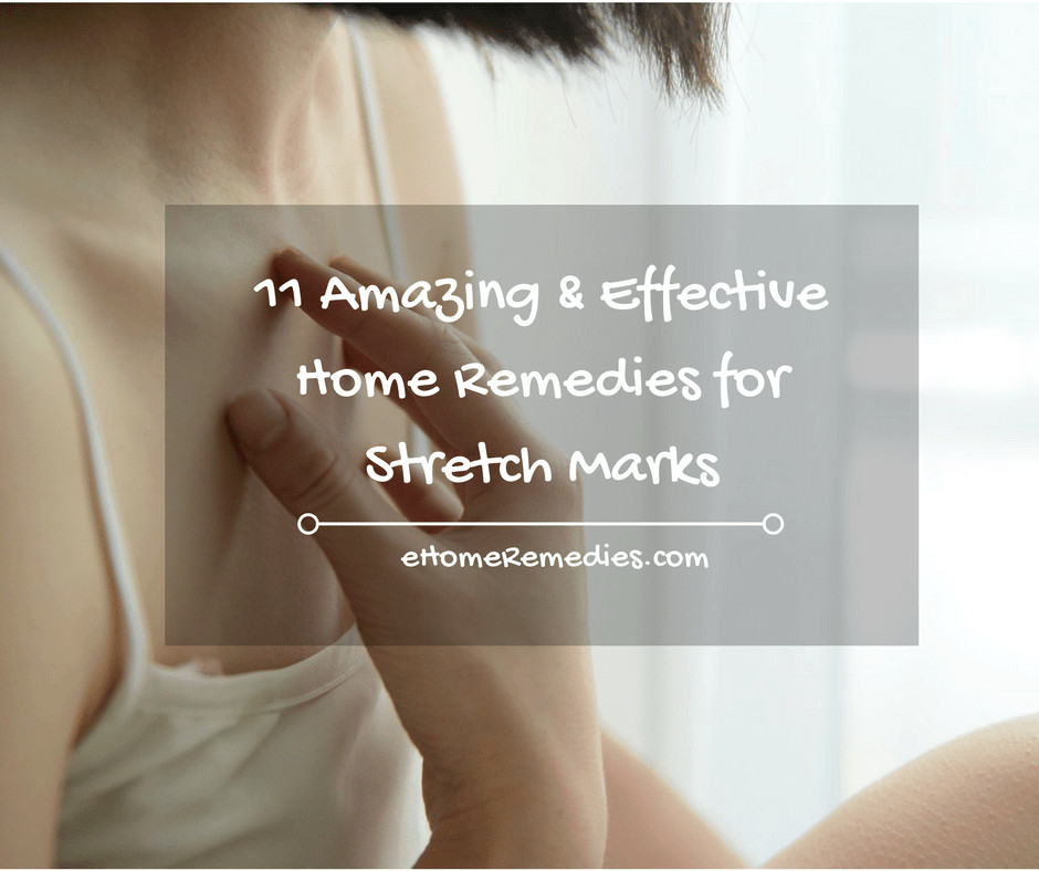 11 Amazing & Effective Home Remedies for Stretch Marks