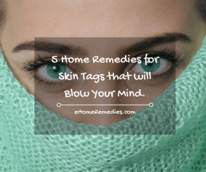 Read more about the article 5 Home remedies for Skin Tags that will Blow Your Mind