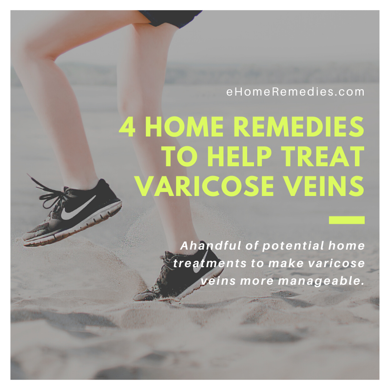 Home Remedies to Help Treat Varicose Veins
