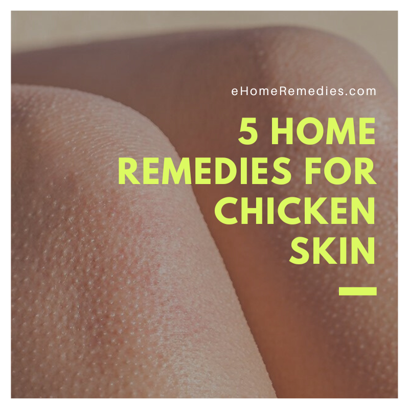 Home Remedies For Chicken Skin