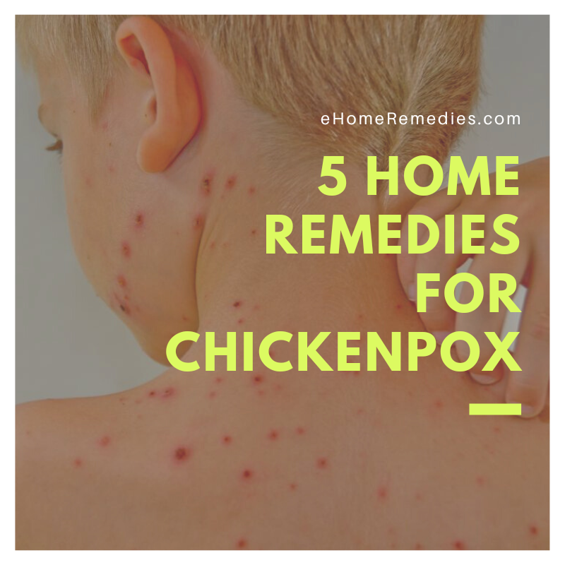 Read more about the article 5 Home Remedies For Chickenpox