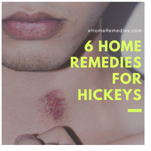 Read more about the article 6 Home Remedies For Hickeys