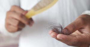 Read more about the article 16 Home Remedies for Hair Thinning at the Crown: Science-Backed Botanical and Biblical Restorations